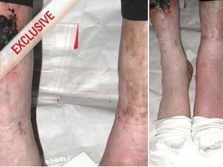 Close up of MJ showing Skin disorder